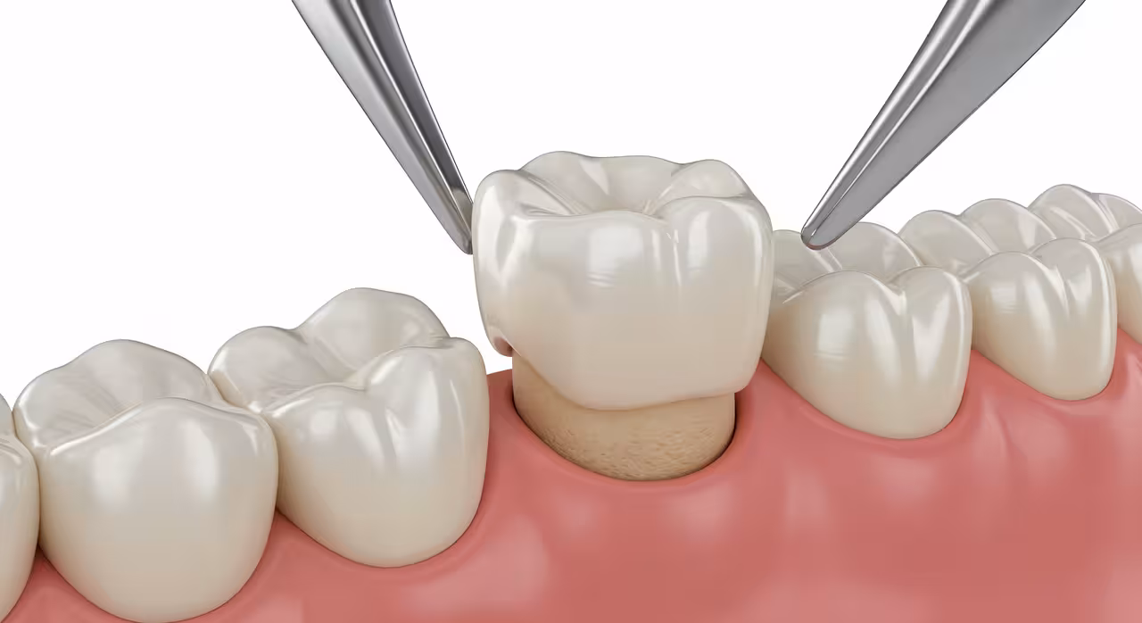 Dental Crowns in Riverview, FL
